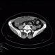 Crohn's disease, subtotal colectomy, ileosigmoid anastomosis: CT - Computed tomography